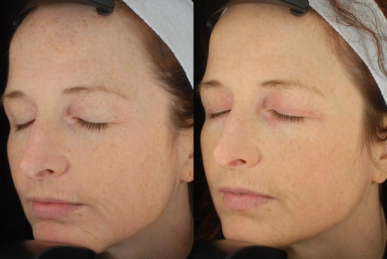 Light and Laser Treatments - Zel Skin & Laser Specialists - now ...