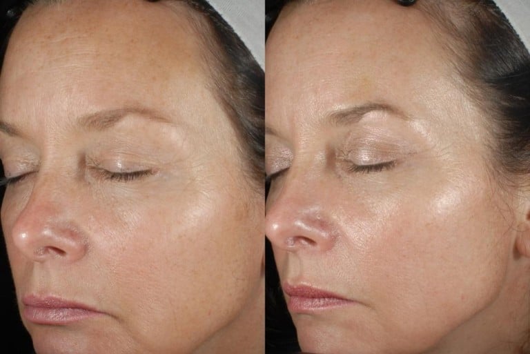 Light and Laser Treatments - Zel Skin & Laser Specialists - now ...