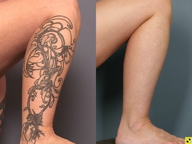 Laser Tattoo Removal in Minneapolis  Edina  Plymouth  Zelskincom