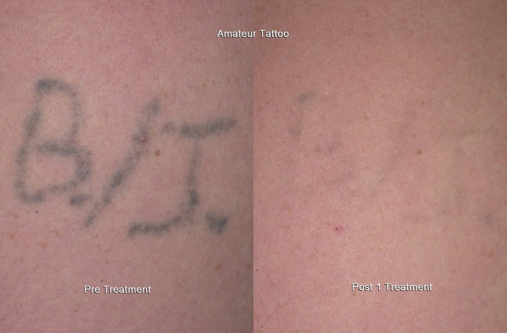 Renewal Laser Clinic  Laser Tattoo Removal  Minneapolis