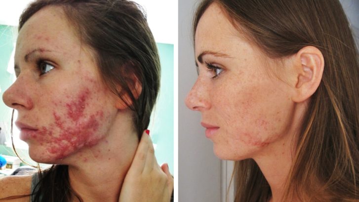 Accutane For Acne Treatment Zel Skin And Laser Specialists And Laser Specialists