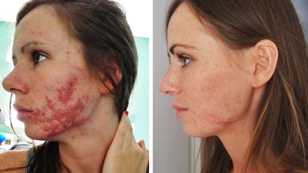 Acne Pop Up What Is Accutane Zel Skin Laser Specialists Now 